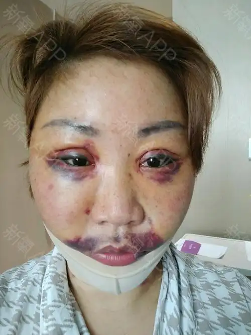 拉皮手术提升好不好_效果图_氧气zdez3拉皮手术提升术后第8天_新氧