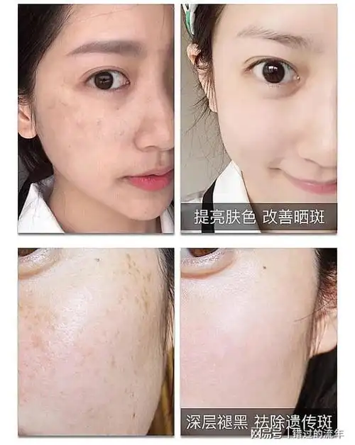 淡斑祛斑效果排名第一,收藏这几款,口碑之选|美白|色斑|精华液|敏感