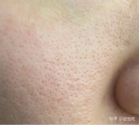 以前哥们的脸是真的糙啊,不仅毛孔大,还坑坑洼洼的.