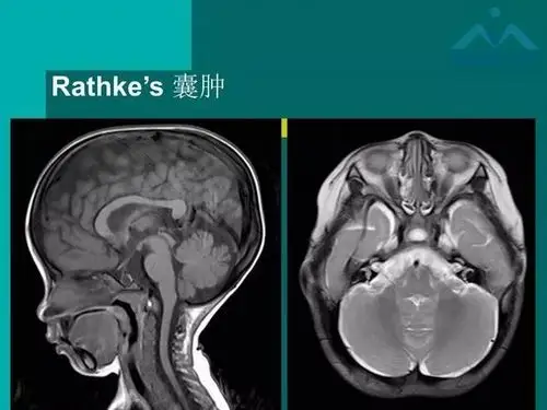 儿童rathke裂囊肿的影像与临床 | 影像天地