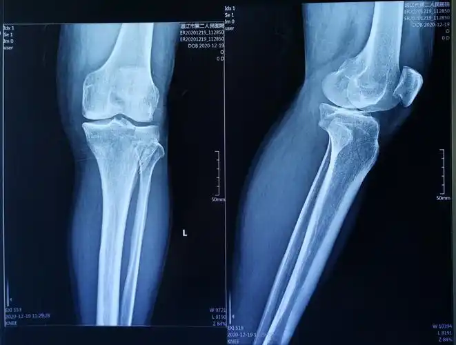 65岁胫骨平台骨折微创复位锁定钢板系统内固定手术一例