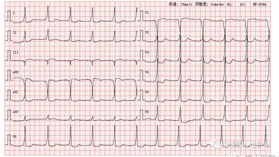 每日读图 || 第1811期 二度二型房室传导阻滞