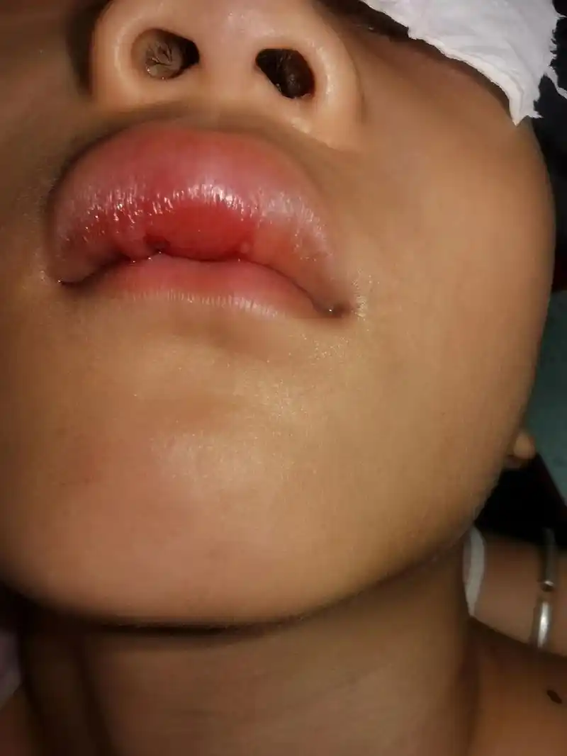 摔破相啦,嘴巴磕破 摔成#嘟嘟唇 哭着哭着睡啦,嘴巴里还一直 - 抖音