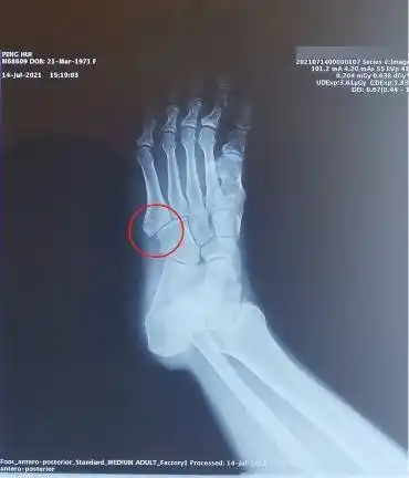 北京素兰医疗诊所第五跖骨骨折案例分享