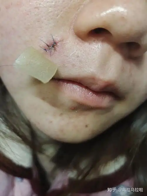 记录皮肤研究所切痣