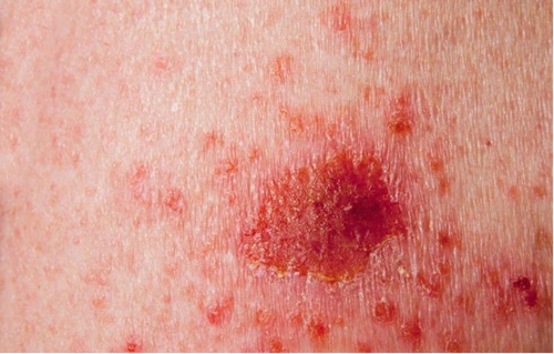 图说:这些斑点都是皮肤癌的前兆