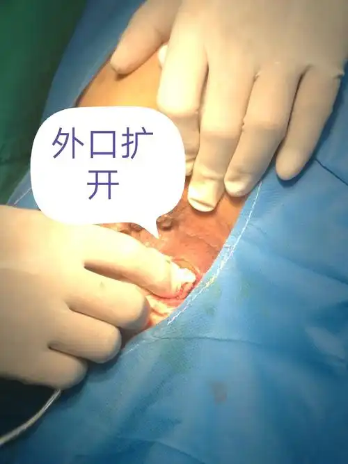 炎性肠病伴肛瘘(半马蹄型肛瘘)手术,术者秦澎湃