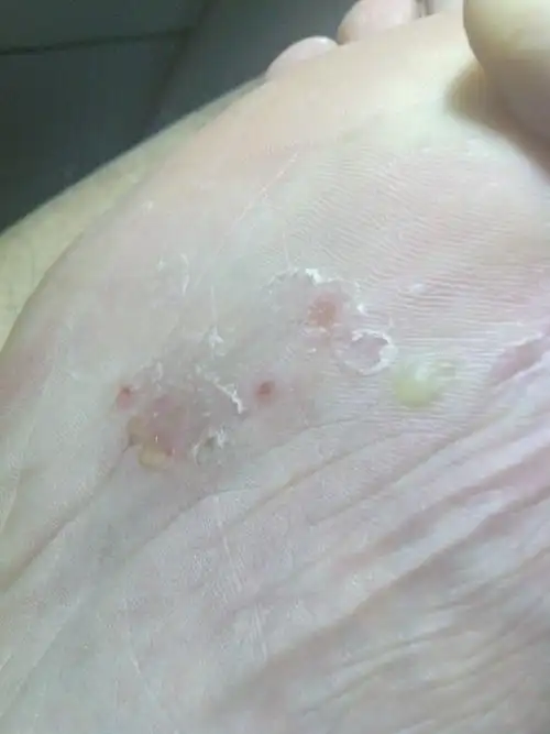 脚底起水泡 很痒 看图 (温馨提示:以下图片可能引起您的不适,慎入)