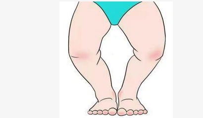 宝妈要注意,小心宝宝长o型腿!