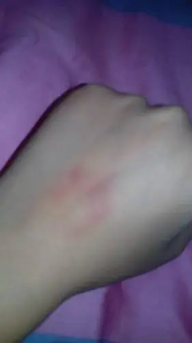 为什么输液后手上会出现这样的一块淤色