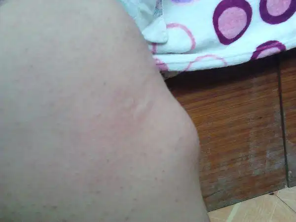 我的膝盖下面有个包,但又像骨头,一按就痛.