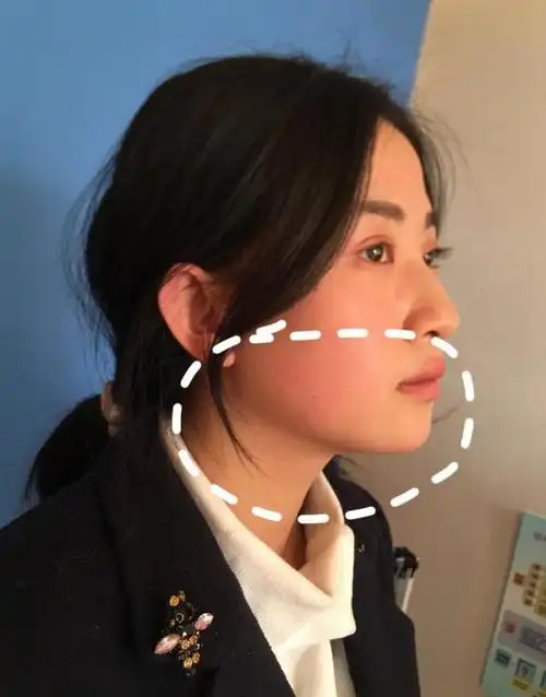 然而,很多人都面临着下颌边缘不清晰的问题,不论是双下巴还是下颌线条