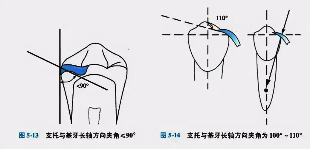牙科医生讲义:牙列缺损可摘局部义齿组成及其作用 第三讲