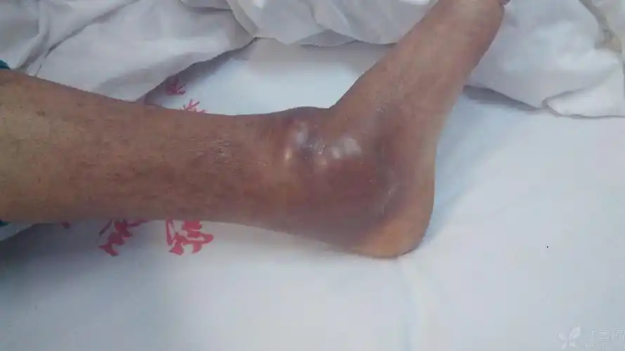 患者性别:男 患者年龄:52 简要病史: 右踝关节反复肿痛20余年 体格