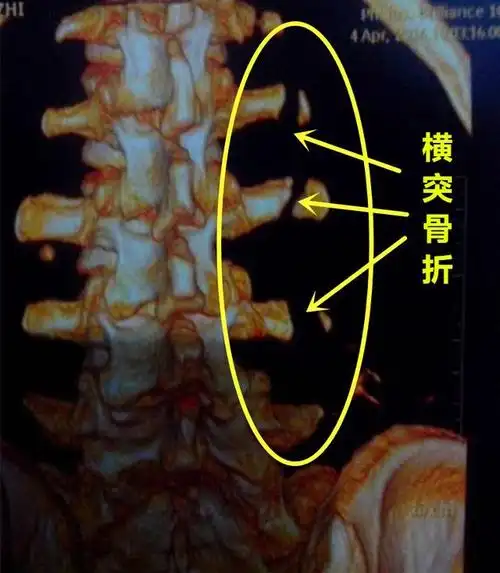 大夫们目前能够很确定地告诉人人丛明晨是腰椎横突骨折(腰1~腰4),然则