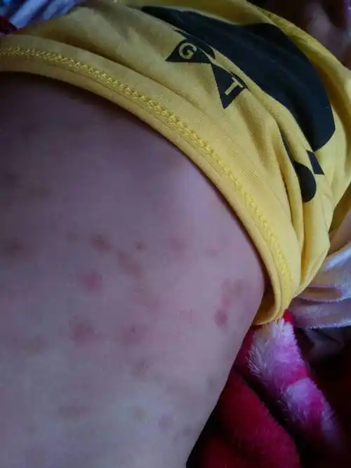 十一个月的宝宝,身上长这种红的,是怎么回事,我给她用过很多种软膏,擦