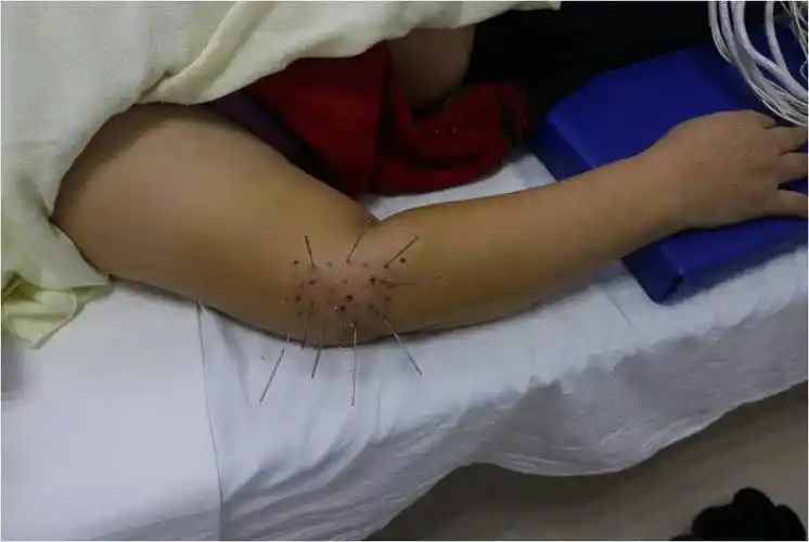 内热针治疗肱骨外上髁炎