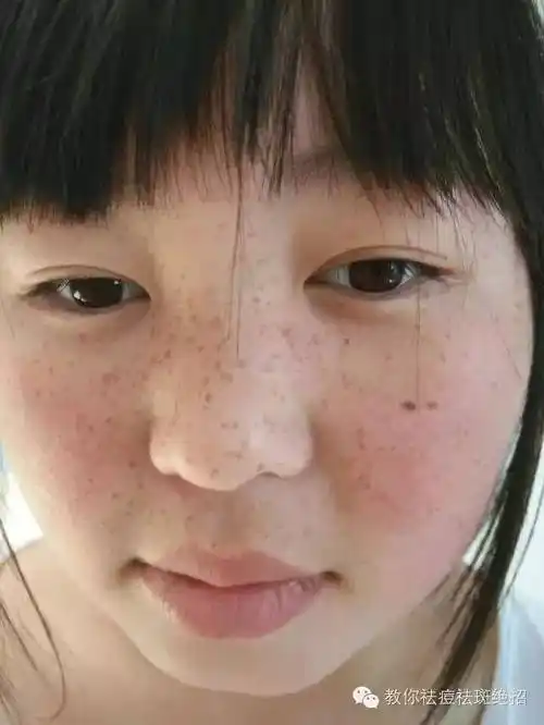 脸上长斑是什么原因引起的