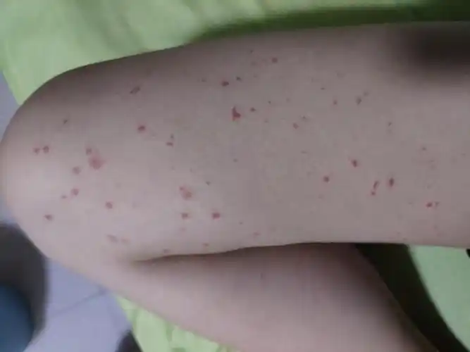 慎入打疫苗过敏了有一样的吗