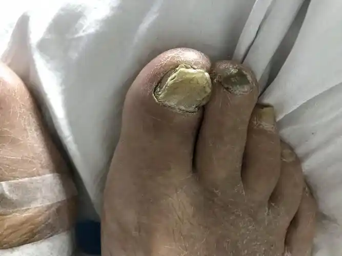 那些灰指甲需要口服药? - 好大夫在线