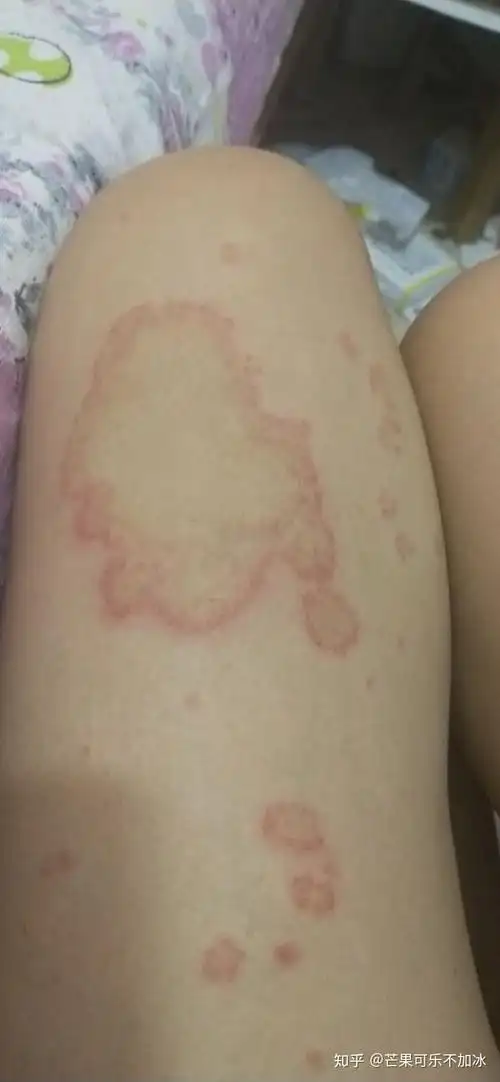 困扰我十多年的环状红斑?荨麻疹?还是季节性过敏? - 知乎
