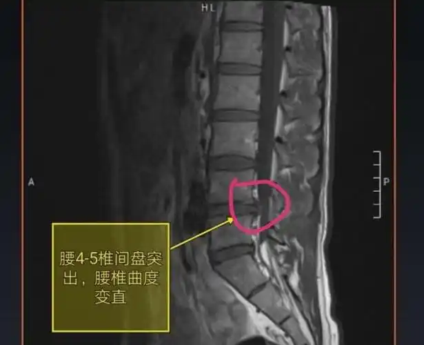 保守治疗和手术治疗谁才是腰间盘45节突出的最佳选择