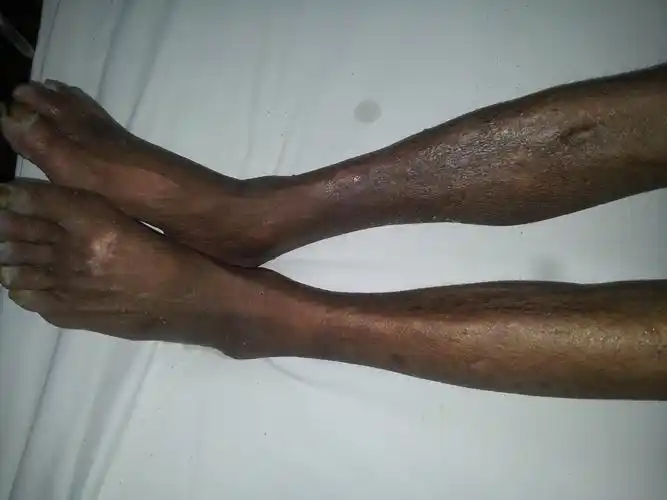 下肢动脉硬化性疾病能否手术急等