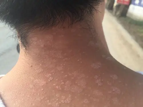 我脖子上突然变成这种一块一块的请问是晒的还是什么皮肤病