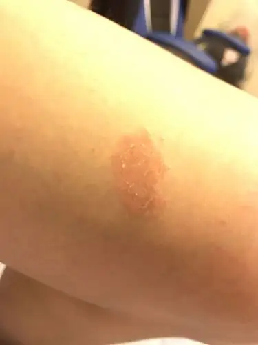 腿上长了一片这个,不痛不痒,表面掉皮,两个月了,现在身上又长出来两三