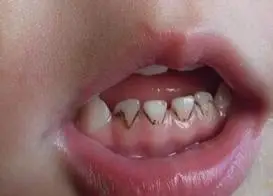 儿童牙齿发黑是什么原因