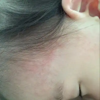 用了宝宝金水两天了也不管用,痱子粉也在用,可好像越长越多了,宝妈们