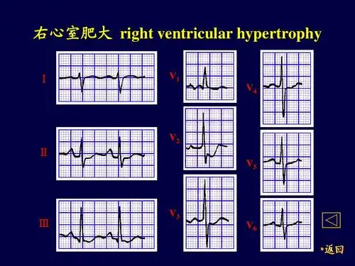 医院心电图学ppt