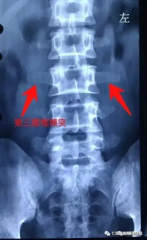 ▍鉴别诊断与腰椎间盘突出症鉴别:腰三横突综合征,横突尖压痛,伴有