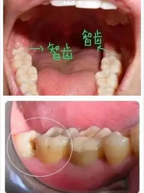 智齿不疼到底拔不拔?看看央视怎么说?