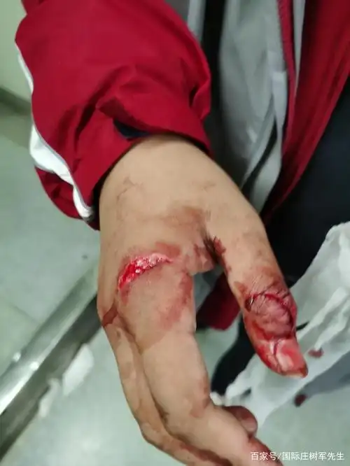 手被刀割伤筋健缝了三针我该怎么办?