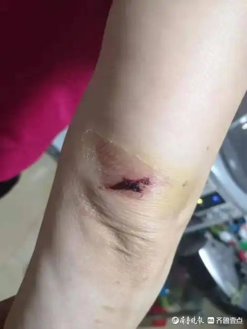 驾驶打开车门时撞倒在地,导致她胳膊,锁骨和腿上都有了不同程度的损伤