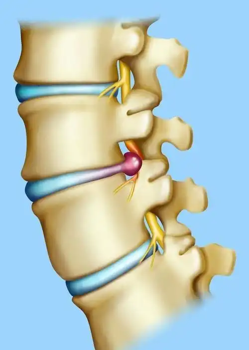腰椎间盘突出不要盲目用药以下三个疗法找到康复新思路