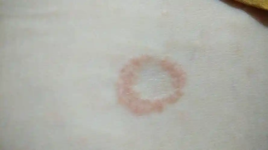 08-01 00:28蒋康伦 医师来自南京大学医院 答: 最常见考虑体癣