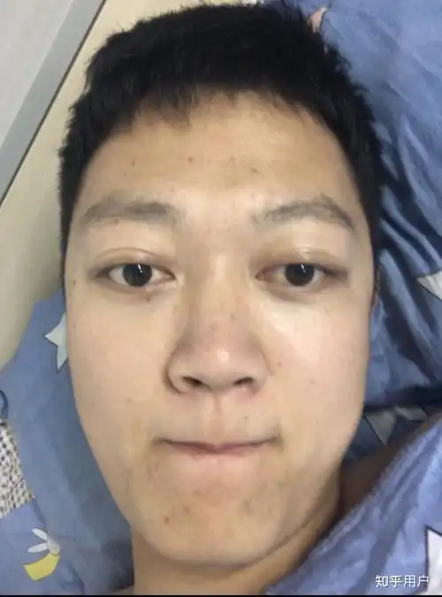 这算眼球突出吗? - 知乎