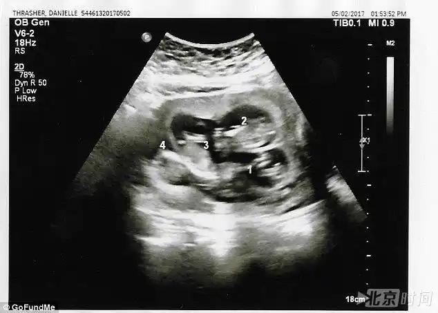 女子怀上四胞胎却面临最艰难选择