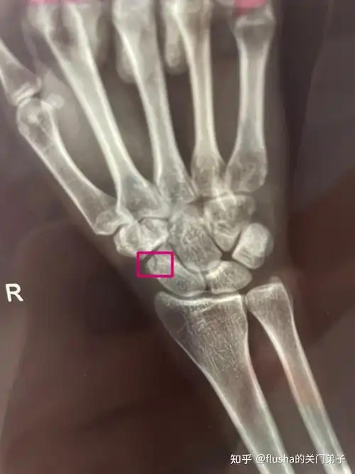 右手手腕舟骨骨折恢复过程