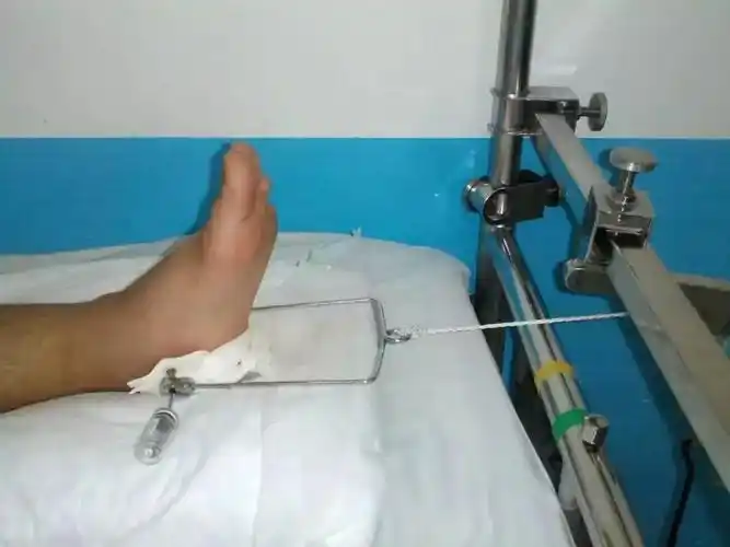 骨科牵引术