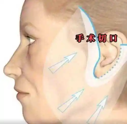 小拉皮手术可以维持多久?看看费用以及恢复期需要做什么