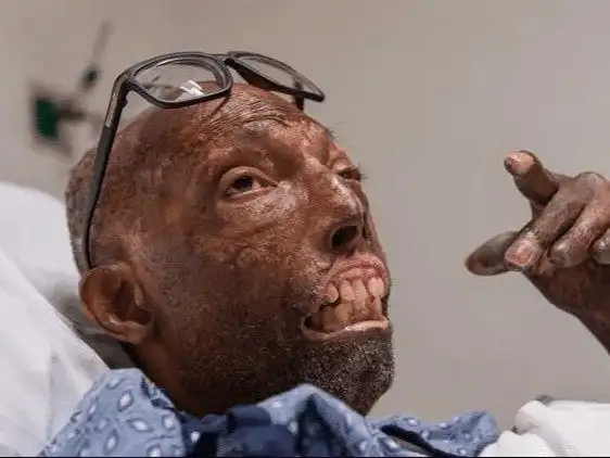 68岁美国黑人接受换脸手术成世界首例他曾坚决拒绝换上白人的脸