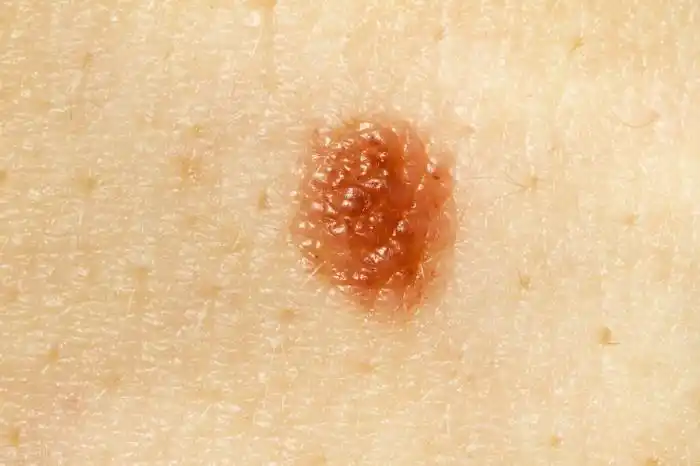 身上长红痣是什么原因(身上突然长了很多小红痣)