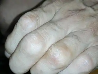 手指关节处有个像茧一样的东西