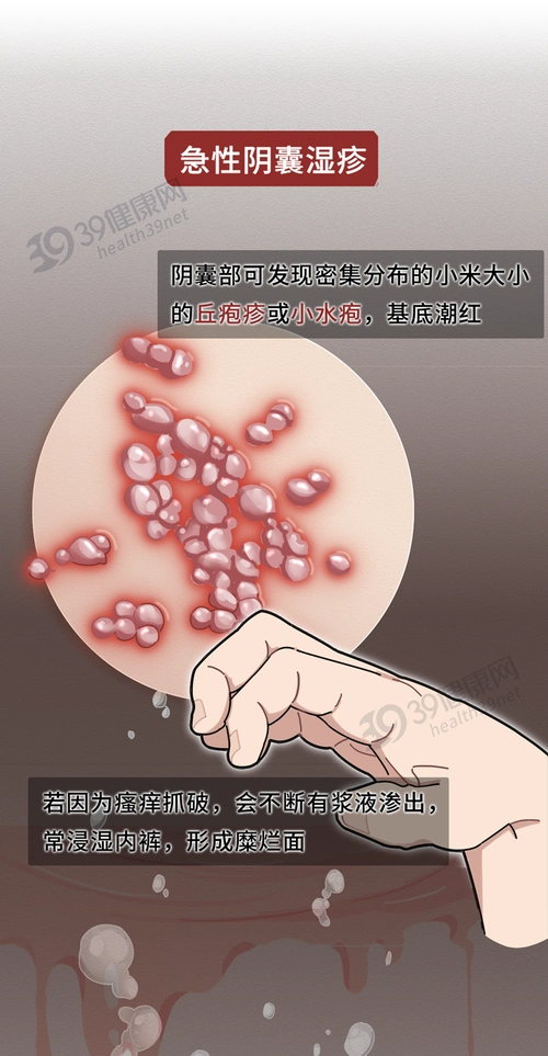 容易复发阴囊湿疹瘙痒剧烈肛门周围,丁丁等处也可能遭殃除了在阴囊的