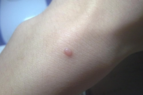 保健常识寻常疣是由人乳头瘤病毒感染所导致,皮肤黏膜出现疣状赘生物