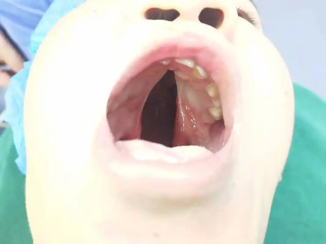 腭裂是一种比较常见的先天性畸形常与唇裂畸形并发.