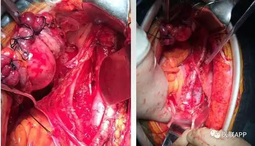 宫颈切除后能活多久 宫颈癌切除后能活多久